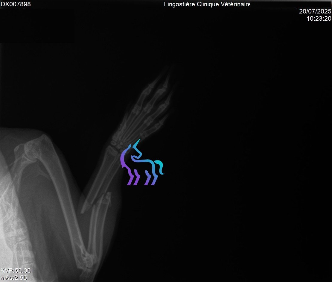 Fracture antérieure