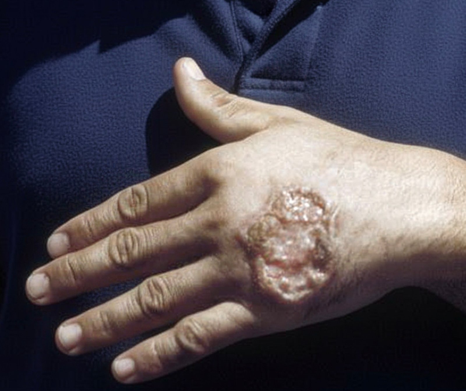 Manifestation cutanée humaine