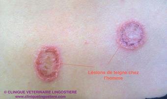 Teigne herpès circiné chez la femme