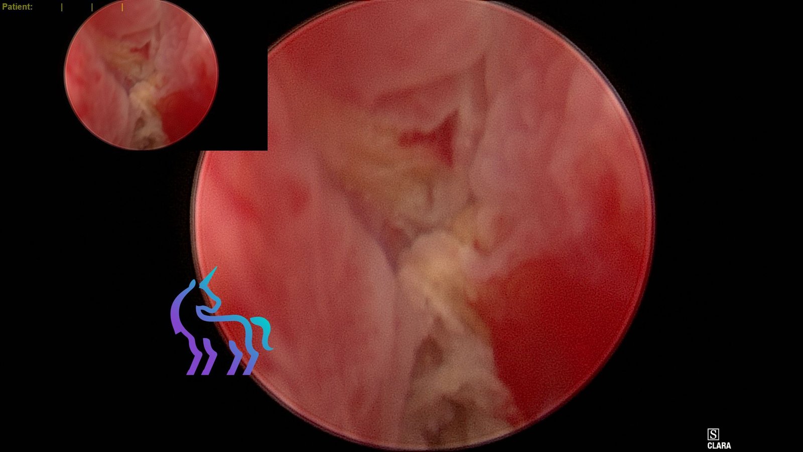 Rhinoscopie chien - Retrait d'un épillet dans les cavités nasales