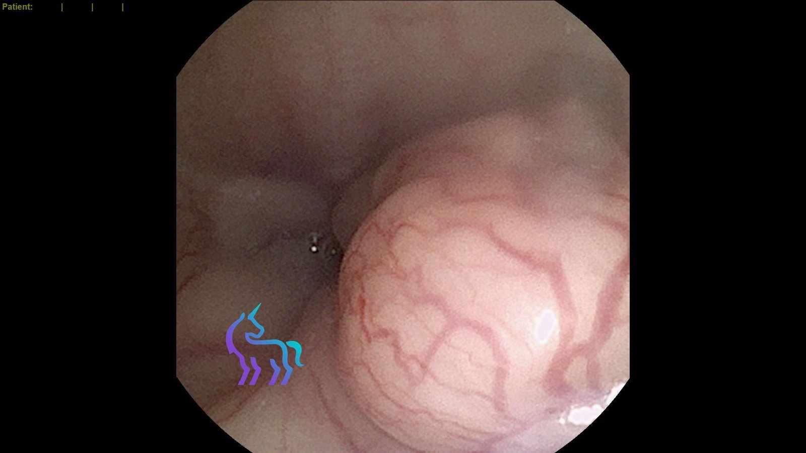 Rhinoscopie rétrograde chat - Lymphome nasopharyngé