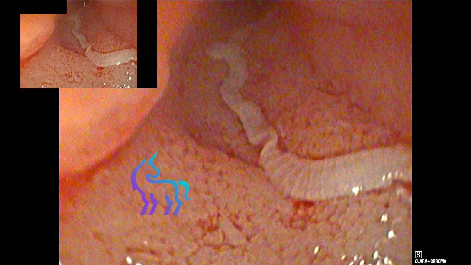 Endoscopie intestinale chat - Visualisation Taenia