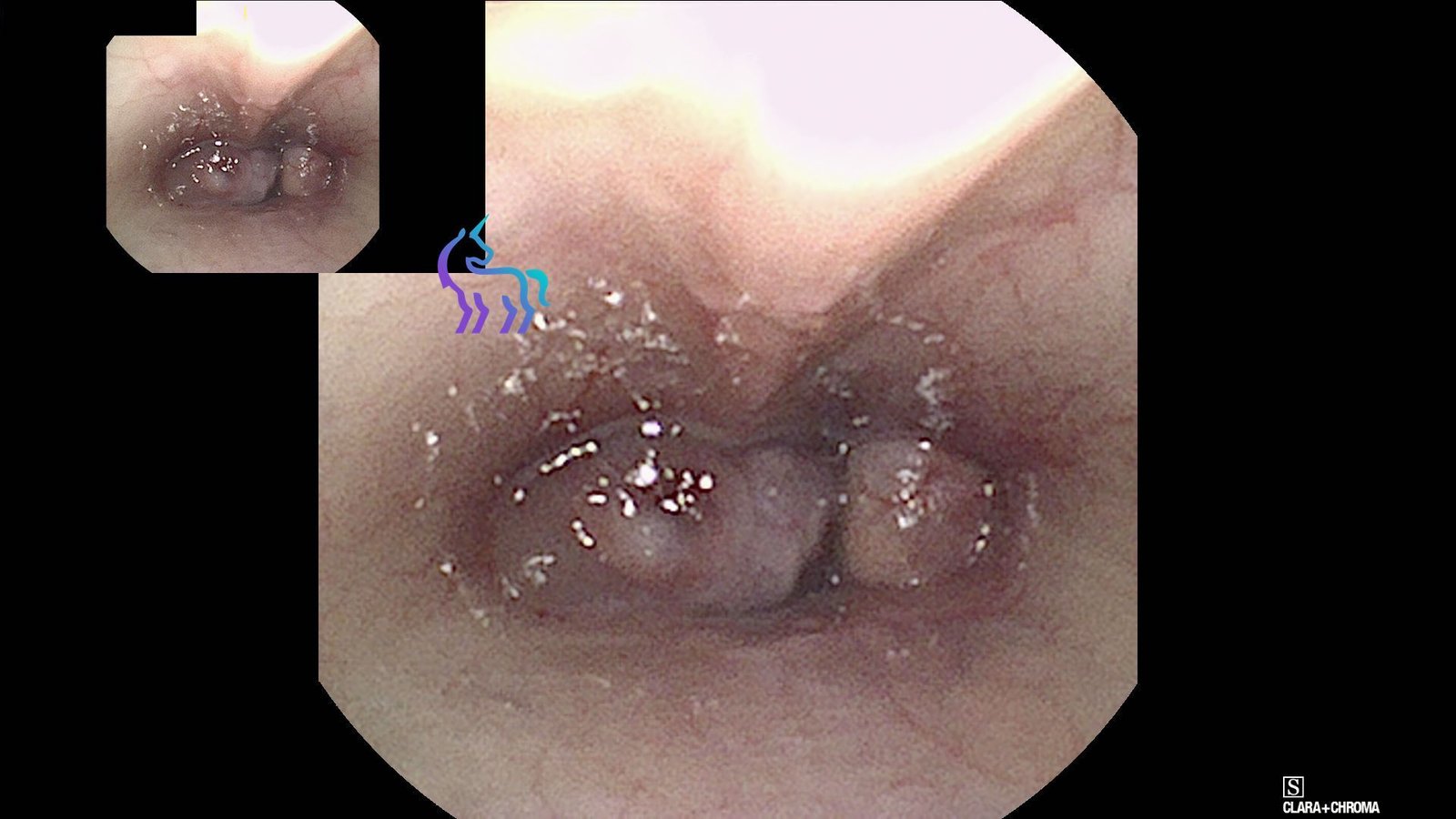 Rhinoscopie rétrograde chat - Masse nasopharyngée