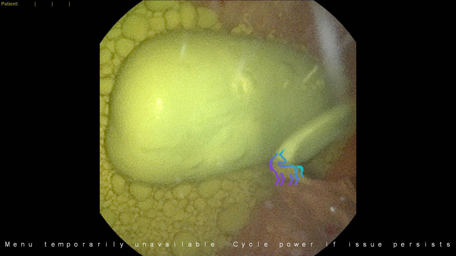 Calculs de xanthine fibroscopie